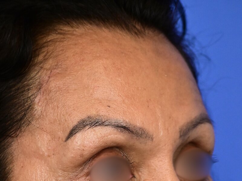 Brow Lift Before & After Image