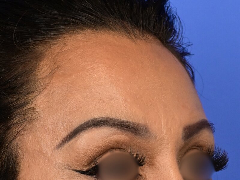 Brow Lift Before & After Image