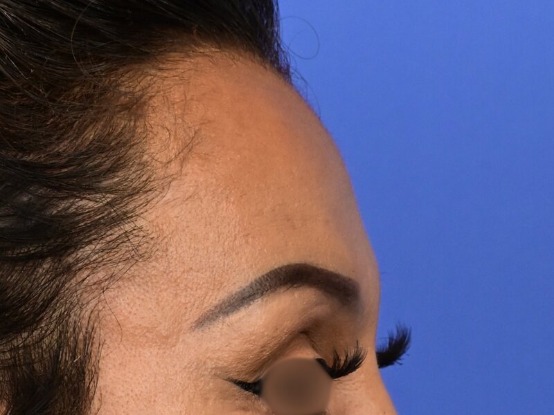 Brow Lift Before & After Image