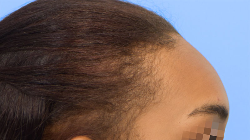 Hairline Advancement Before & After Image