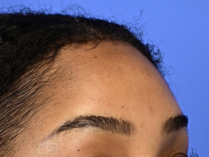 Hairline Advancement Before & After Image