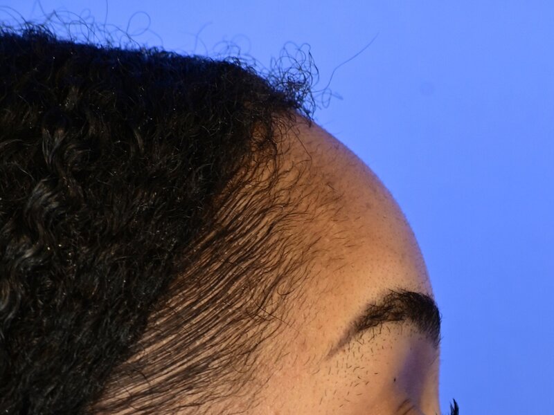 Hairline Advancement Before & After Image