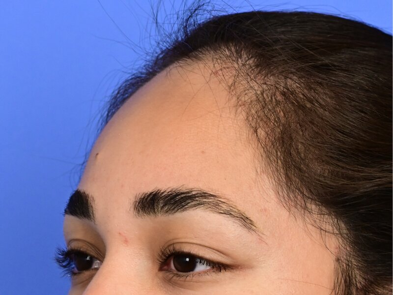 Hairline Advancement Before & After Image