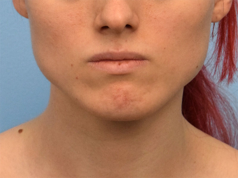 Botox/Dysport/Daxxify Before & After Image