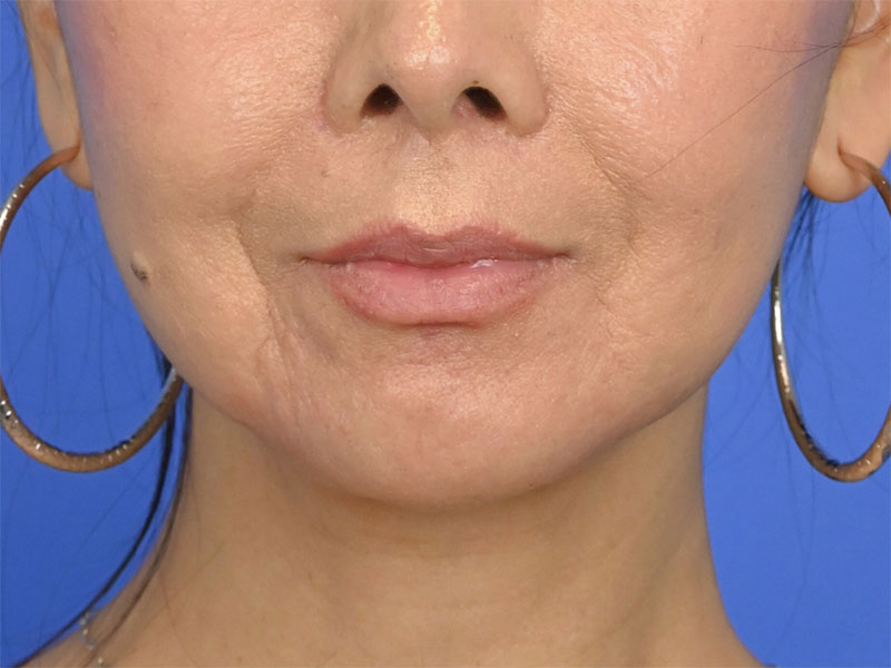 Lip Lift Before & After Image