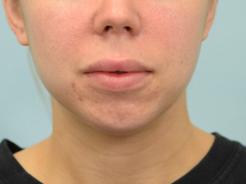 Lip Lift Before & After Image