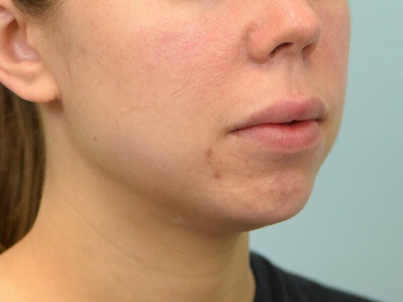 Lip Lift Before & After Image