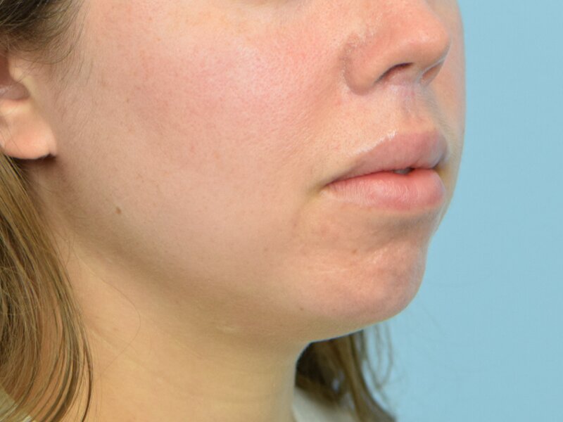 Lip Lift Before & After Image