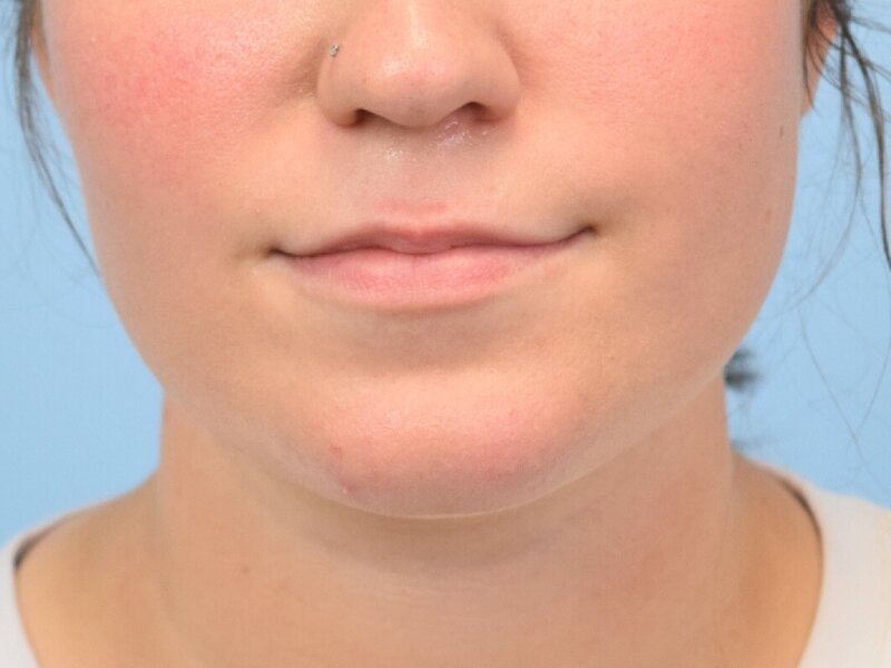 Lip Lift Before & After Image