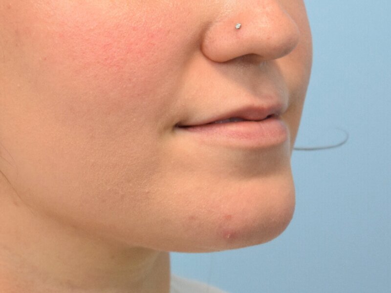 Lip Lift Before & After Image