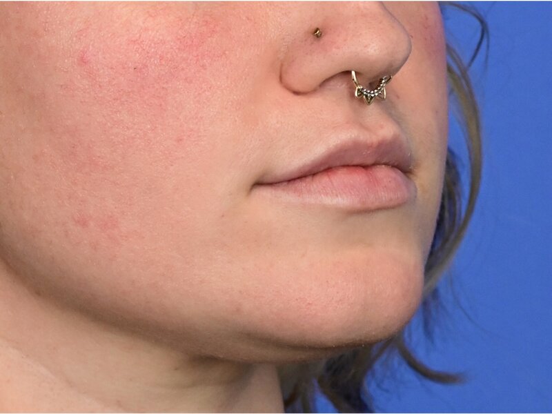 Lip Lift Before & After Image