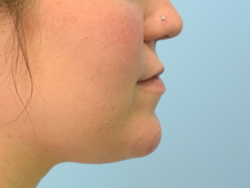 Lip Lift Before & After Image