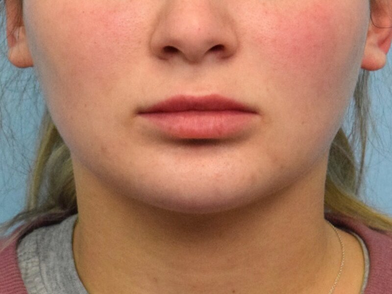 Lip Lift Before & After Image