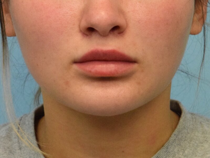 Lip Lift Before & After Image