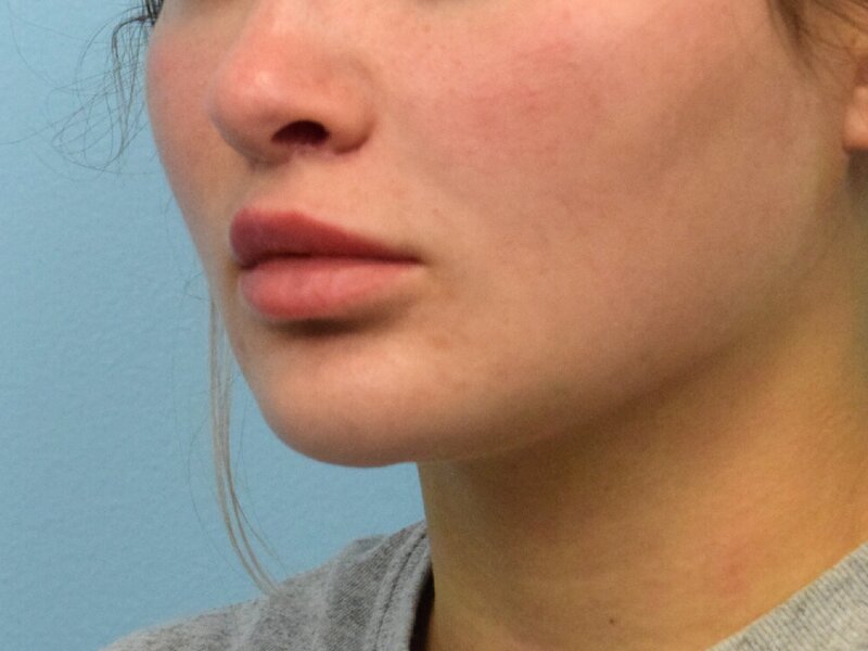 Lip Lift Before & After Image