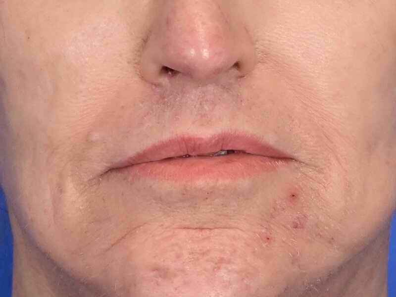 Lip Lift Before & After Image