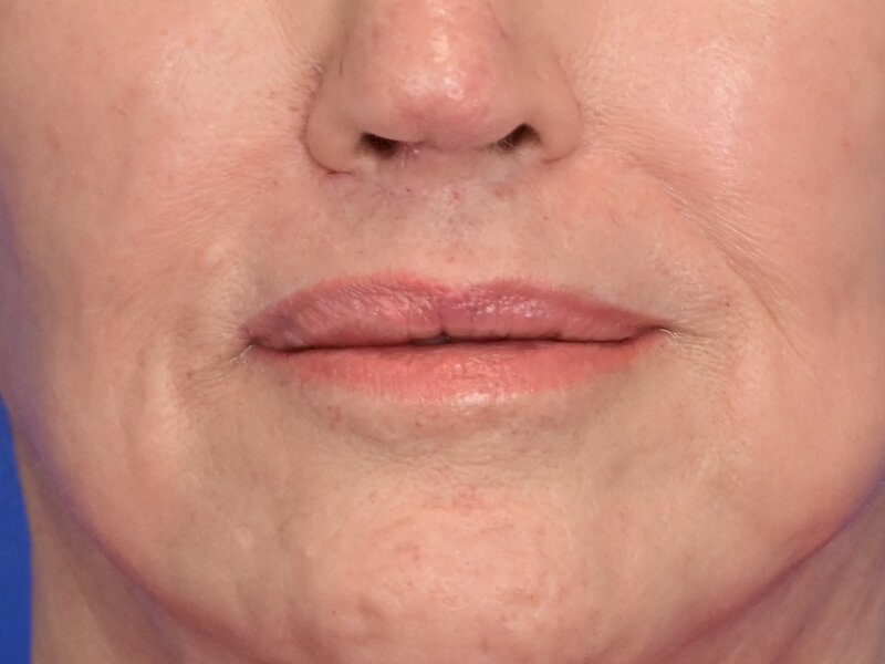 Lip Lift Before & After Image