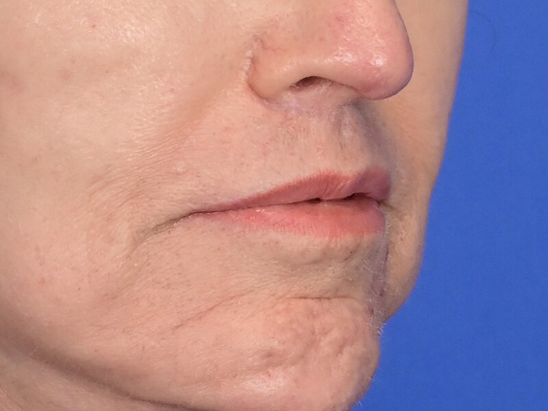 Lip Lift Before & After Image