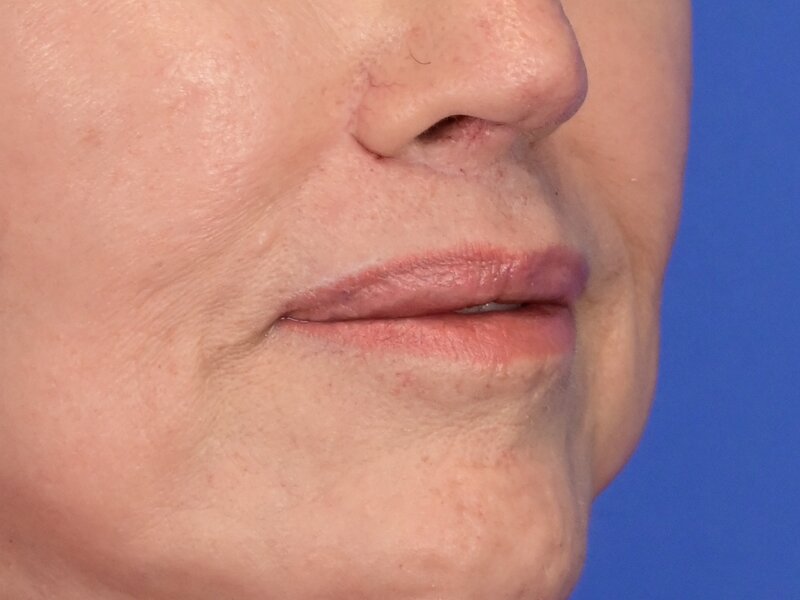 Lip Lift Before & After Image