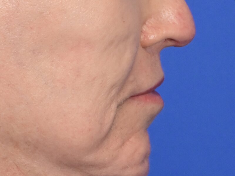 Lip Lift Before & After Image