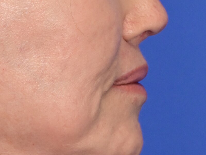 Lip Lift Before & After Image