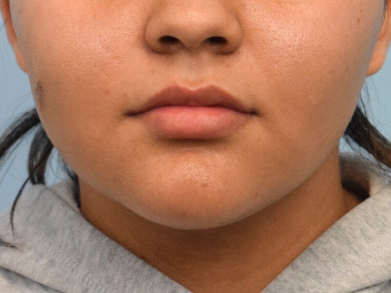 Lip Lift Before & After Image