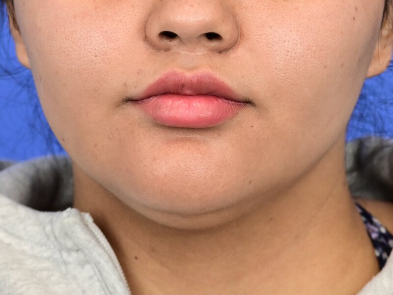 Lip Lift Before & After Image