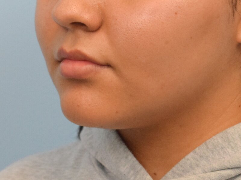 Lip Lift Before & After Image