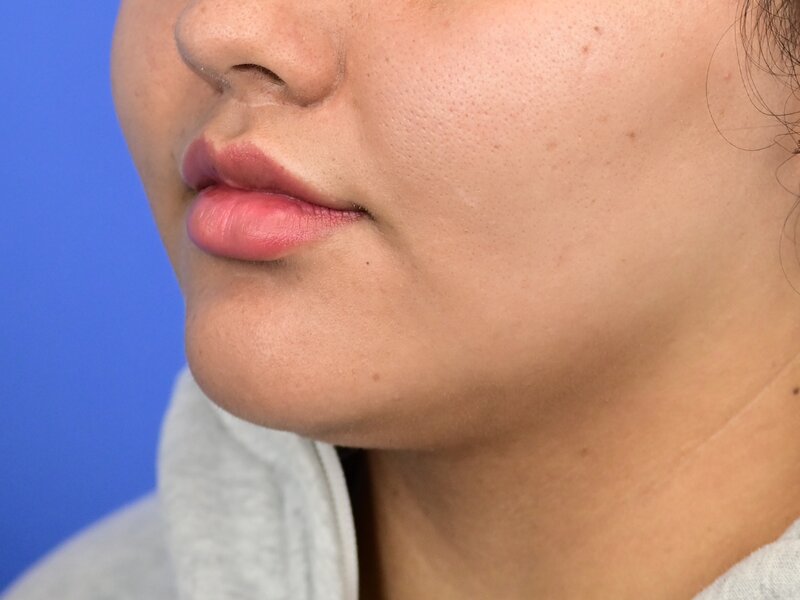 Lip Lift Before & After Image