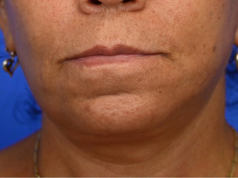 Lip Lift Before & After Image