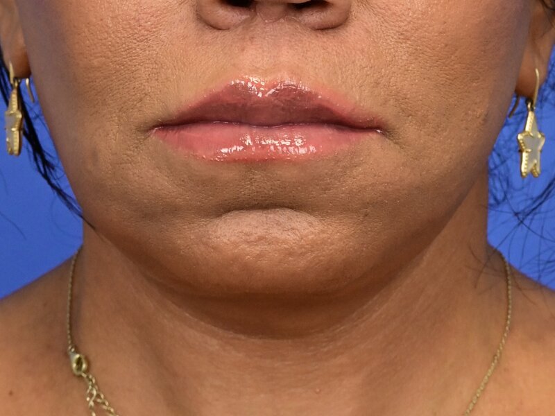 Lip Lift Before & After Image