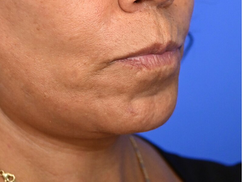 Lip Lift Before & After Image