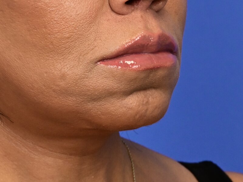 Lip Lift Before & After Image