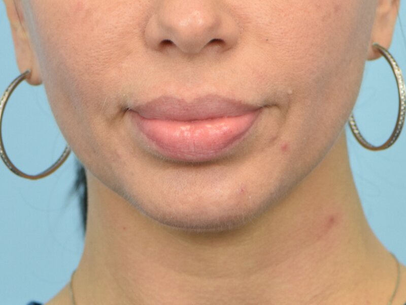 Lip Lift Before & After Image