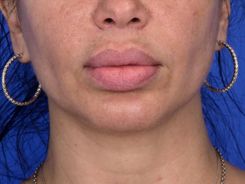 Lip Lift Before & After Image