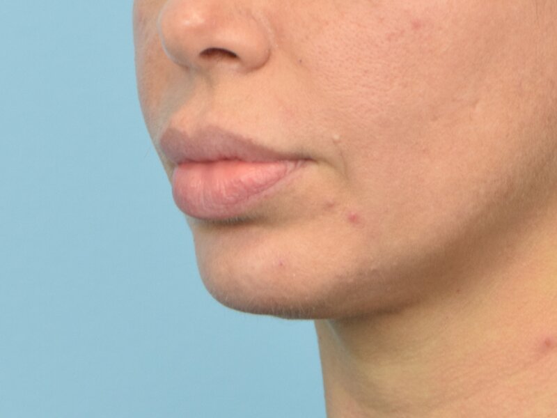 Lip Lift Before & After Image