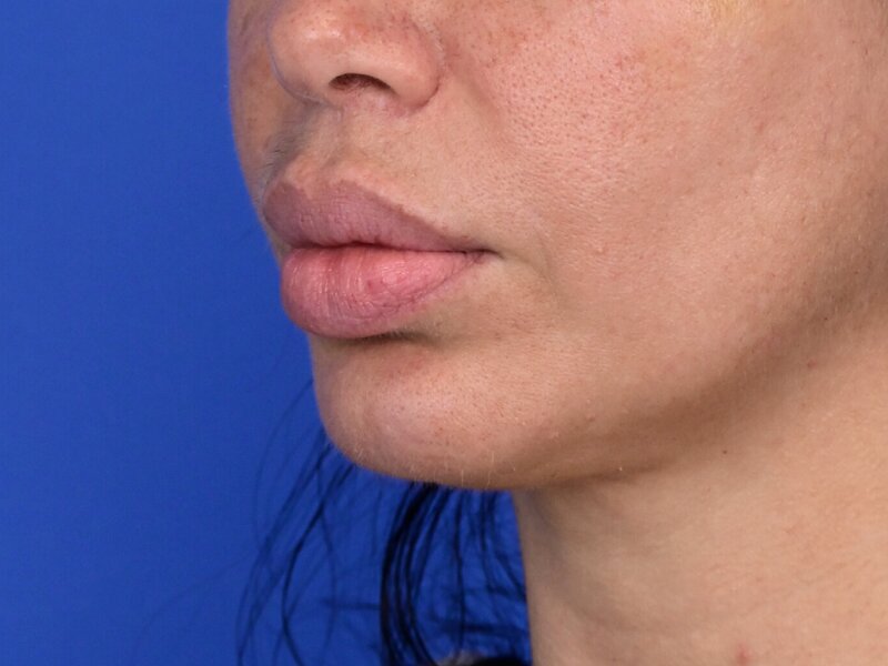 Lip Lift Before & After Image