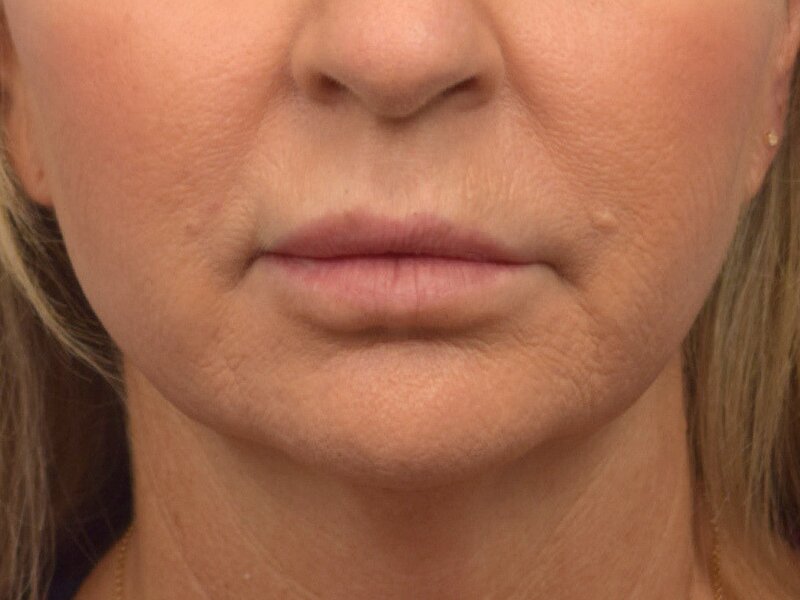 Lip Lift Before & After Image