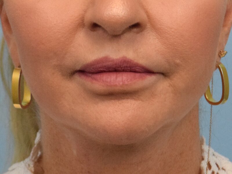 Lip Lift Before & After Image