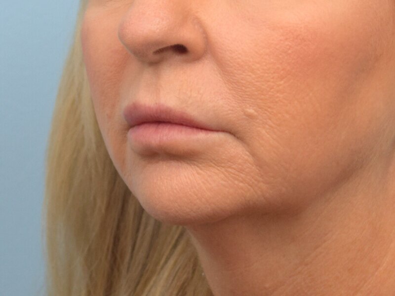 Lip Lift Before & After Image