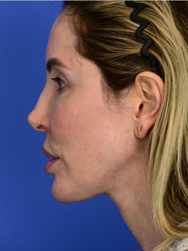 The Tuck Up (Mini Neck Lift) Before & After Image