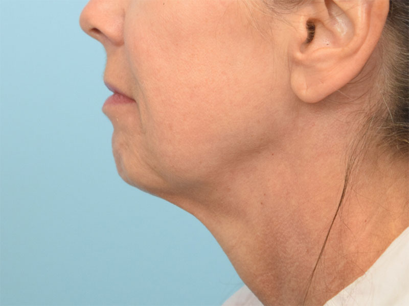 Neck Liposuction Before & After Image