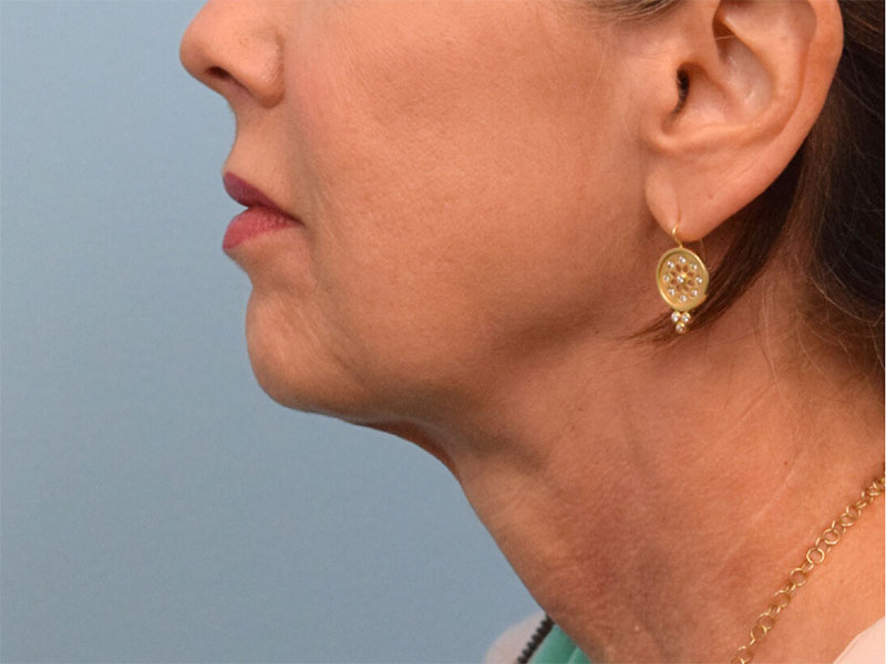 Neck Liposuction Before & After Image