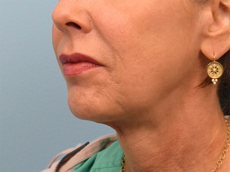 Neck Liposuction Before & After Image