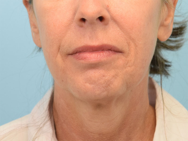 Neck Liposuction Before & After Image