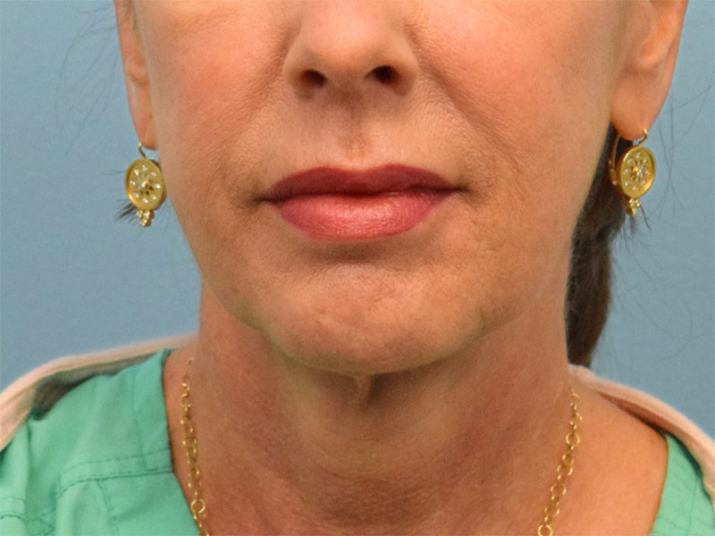 Neck Liposuction Before & After Image