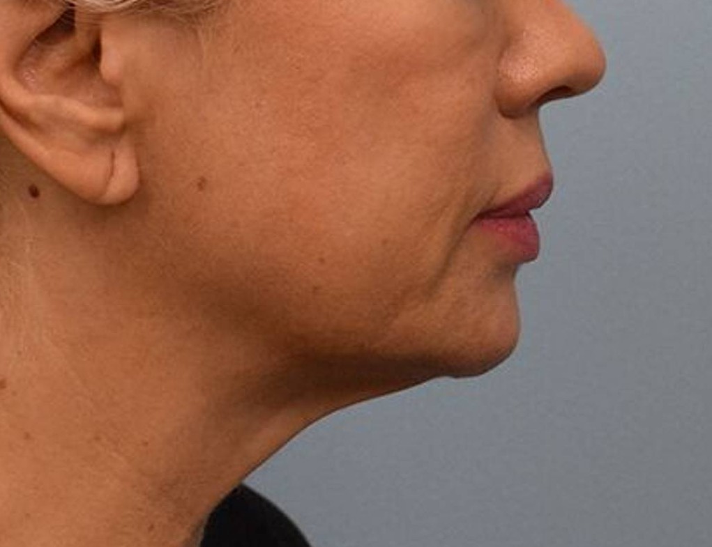 Renuvion Skin Tightening Before & After Image