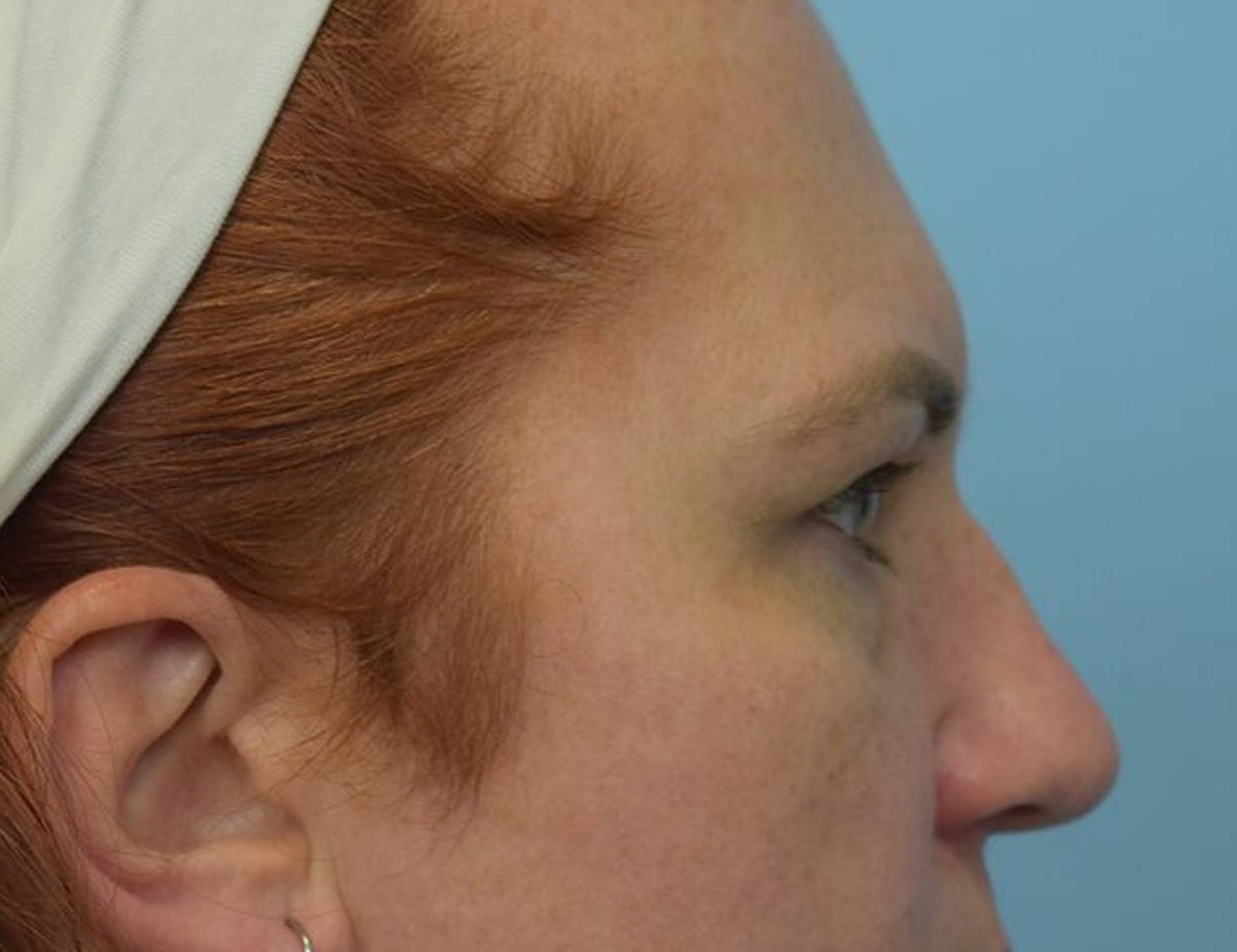 Rhinoplasty Before & After Image