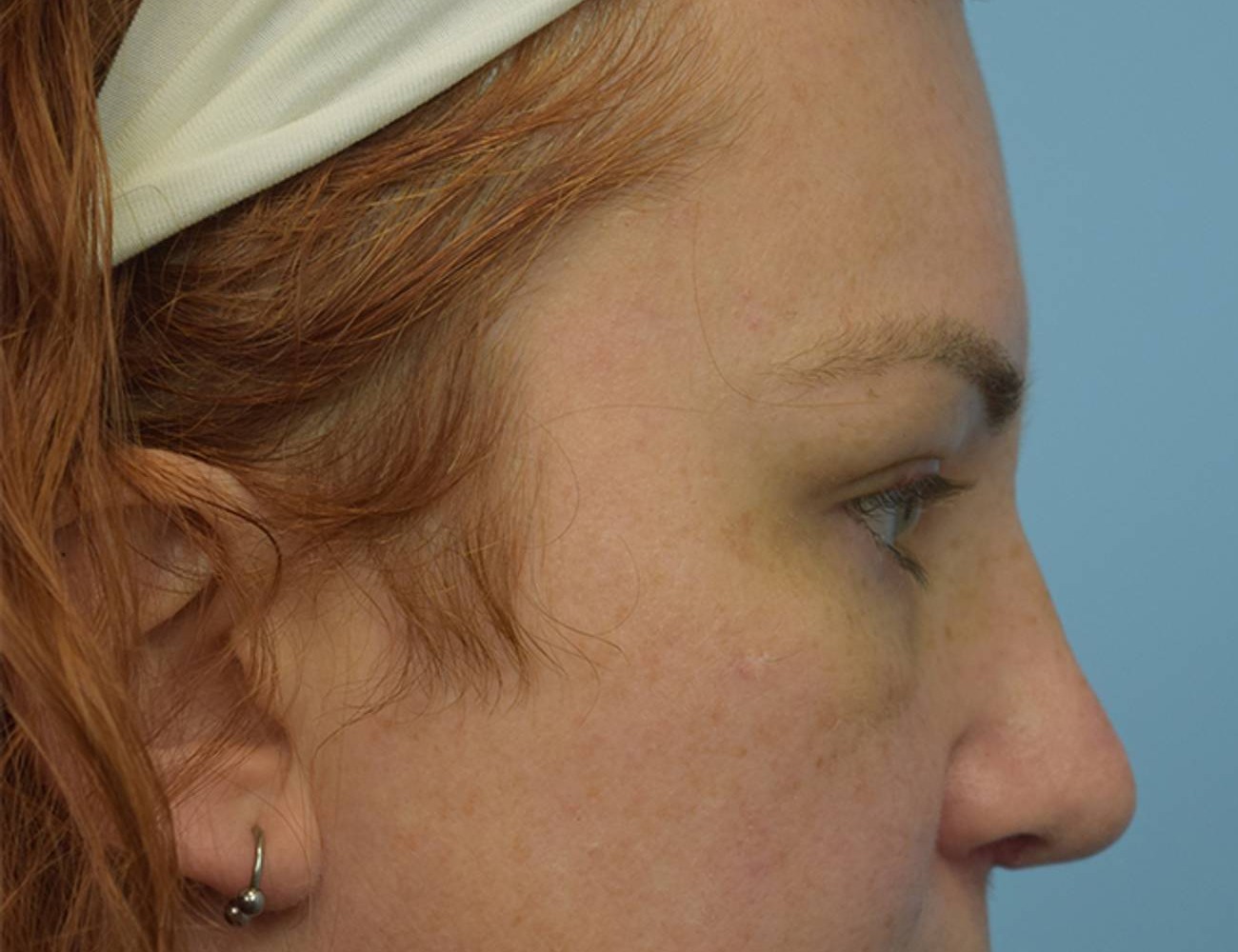 Rhinoplasty Before & After Image