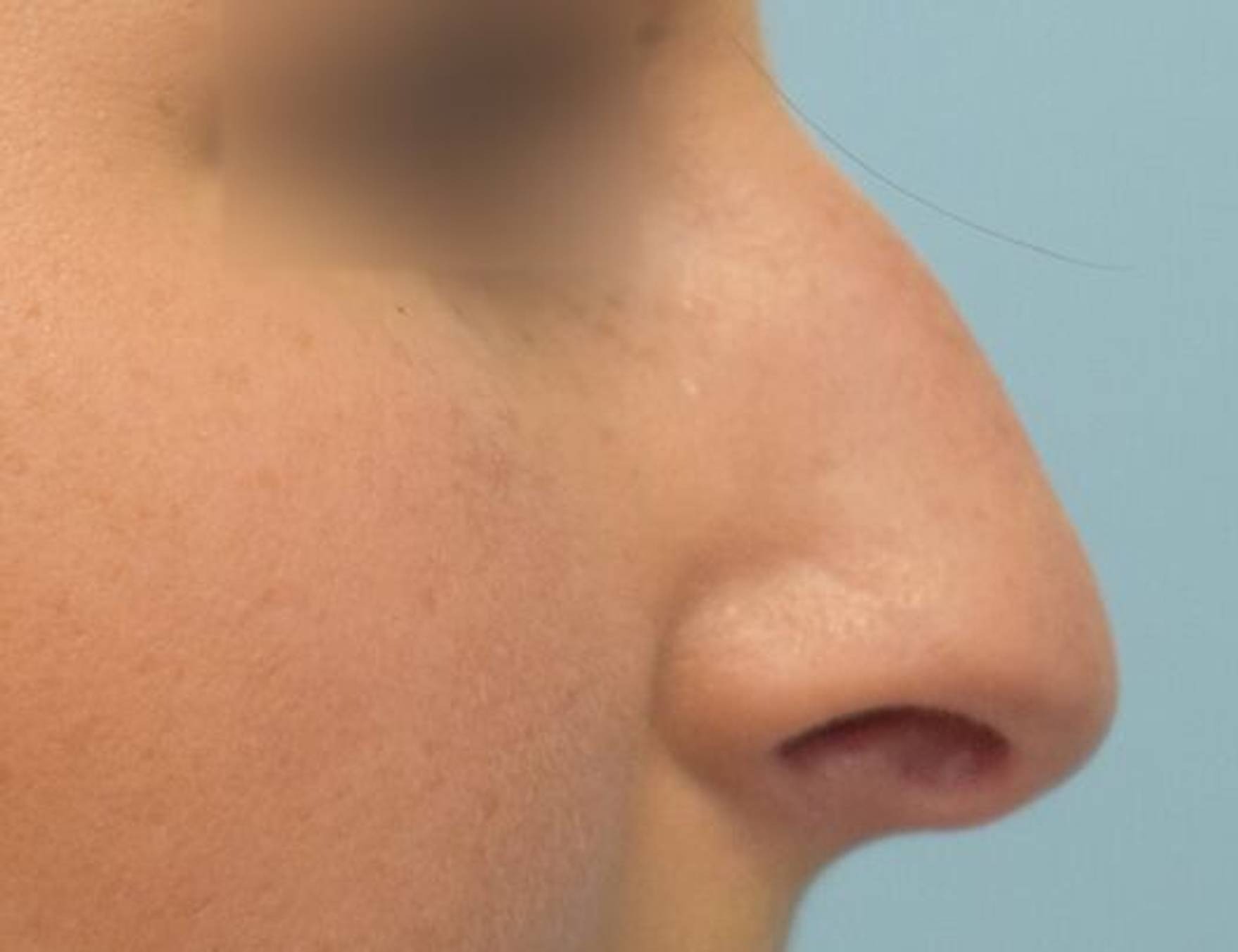 Rhinoplasty Before & After Image